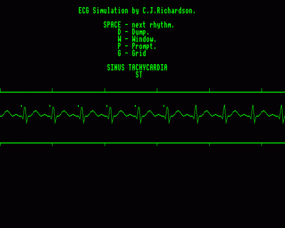 ECG Simulator